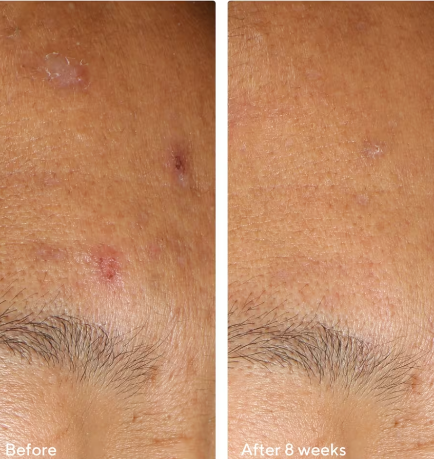 Murad - InvisiScar Resurfacing Treatment 15ml - null - EXprimi Skincare Kenya - #product_page_title#