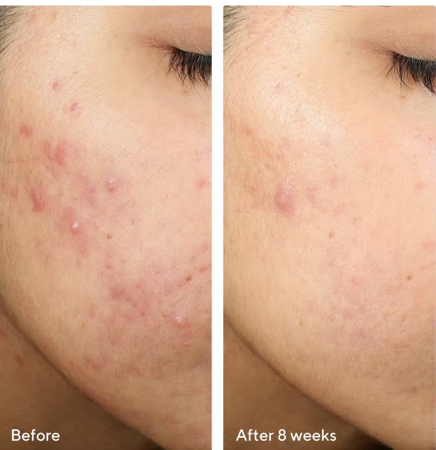 Murad - InvisiScar Resurfacing Treatment 15ml - null - EXprimi Skincare Kenya - #product_page_title#