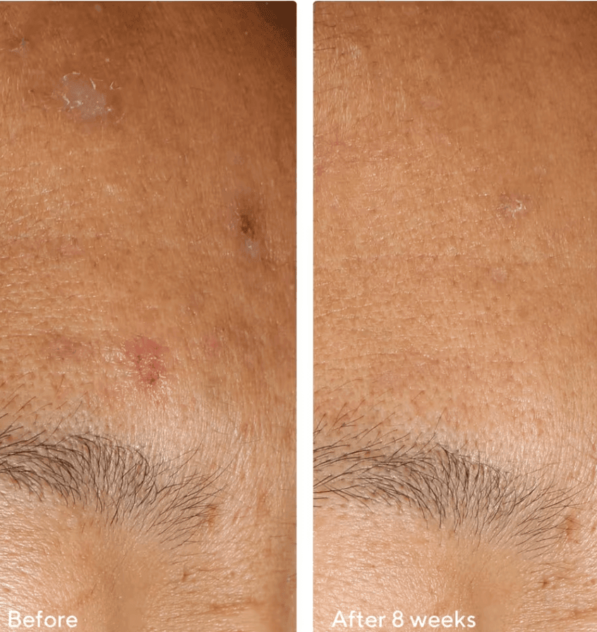 Murad - InvisiScar Resurfacing Treatment 15ml  - null - EXprimi Skincare Kenya - #product_page_title#