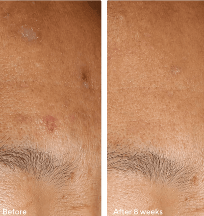 Murad - InvisiScar Resurfacing Treatment 15ml  - null - EXprimi Skincare Kenya - #product_page_title#