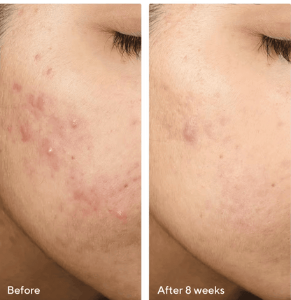 Murad - InvisiScar Resurfacing Treatment 15ml  - null - EXprimi Skincare Kenya - #product_page_title#
