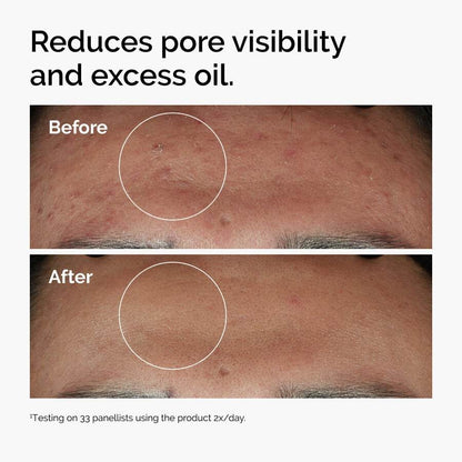 The Ordinary Niacinamide 10% + Zinc 1% Serums ord-niacinamide-zinc-blemish-serum-before-after-pores shop at Exprimi Beauty Kenya. Home of Skin care, Body care, Make-up, Fragrance & Beauty.
